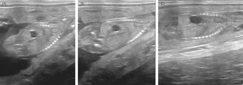 Ultrasound‐guided Fetal Thorax Compression To Reduce Post‐fixation