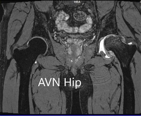 Case Study Management Of Avascular Necrosis Of The Left Hip In A 40