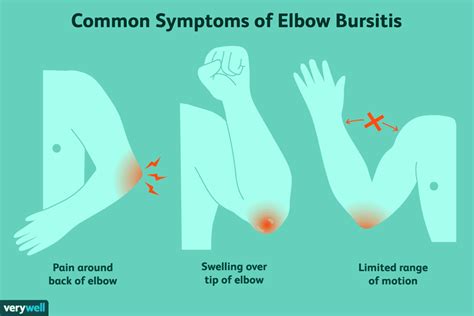 Elbow Olecranon Bursitis Signs And Treatments