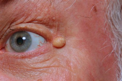 Epidermoid Cyst Infected Causes Symptomstreatment