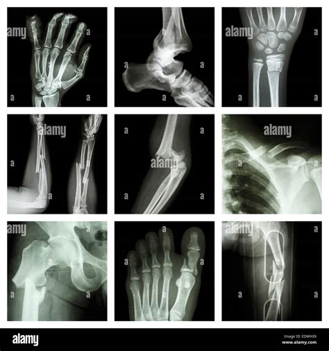 Broken Bone Xray Hi Res Stock Photography And Images Alamy