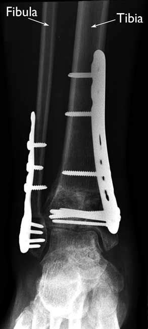 Pilon Fractures Of The Ankle Orthoinfo Aaos Fractures Broken Bone