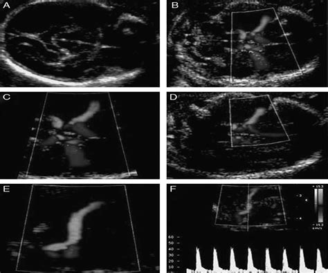 Middle Cerebral Artery Doppler For Managing Fetal Anemia Clinical