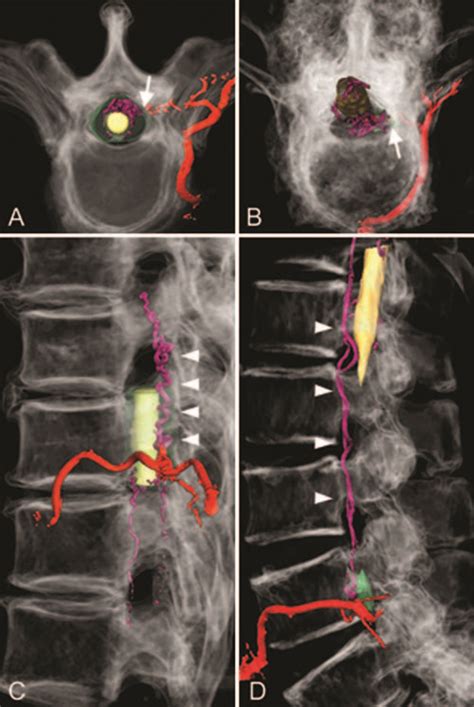 Spinal Dural Arteriovenous Fistula Neurosurgery Blog