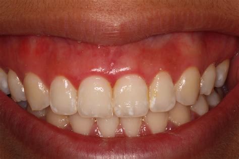 How To Fix Gum Recession Between Teeth Unugtp News