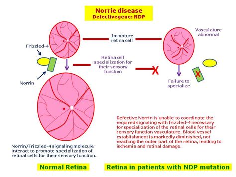 Norrie Disease Hereditary Ocular Diseases