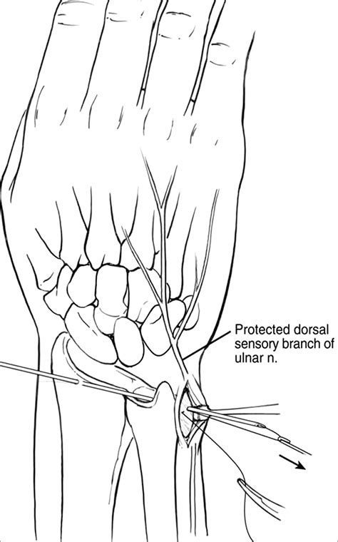 Arthroscopic Treatment Of Type 1b Triangular Fibrocartilage Complex