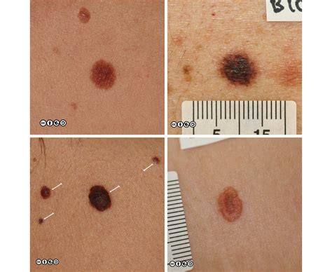 Melanoma Images Early Stages Melanoma Pictures Early Stages Early