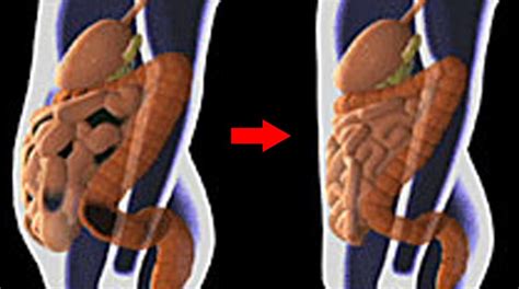 Colon Cleanse Before And After Check More At Colon Healthcolon