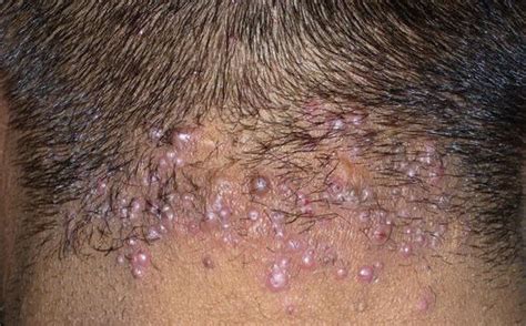 Bumps Pimples Acne Zits Scabs And Sores Panosundaki Pin