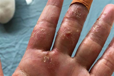 “i Couldnt Bend My Finger” Hand Eczema Misery After Singaporean Woman