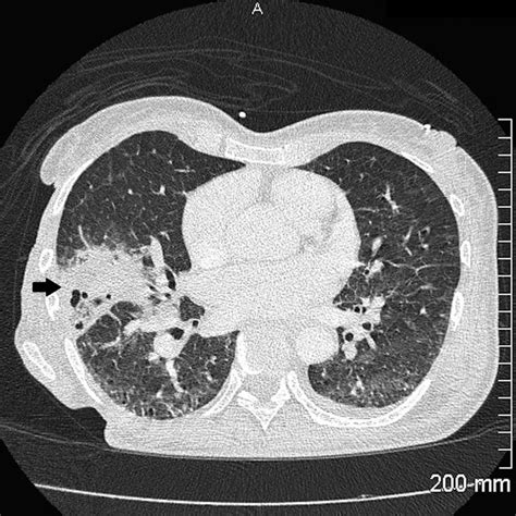 Chest Radiography Showed Focal Consolidation In The Right Middle Lung