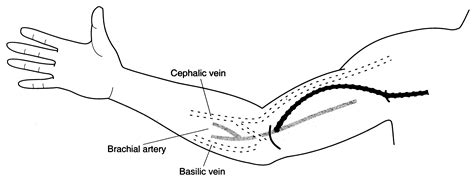 Transposition Of The Basilic Vein For Arteriovenous Fistula An