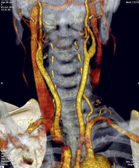 Vietnamese Medic Ultrasound Case Ectopic Thyroid Gland Dr Phan