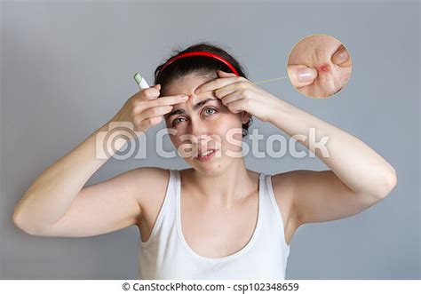 Teenage Woman Squeezes Pimples On Her Forehead Holding A Concealer