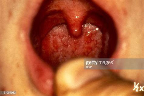 Chronic Tonsillitis Pharyngitis Pictures Getty Images