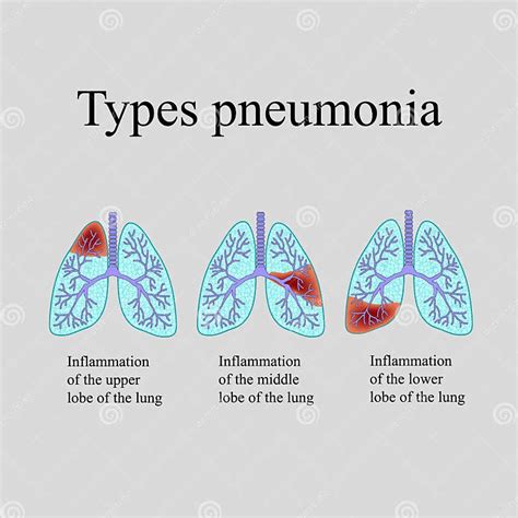 Pneumonia The Anatomical Structure Of The Human Lung Type Of