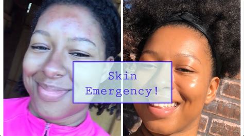 Skin Emergency How I Got Rid Of Mosquito Bite Scars Youtube