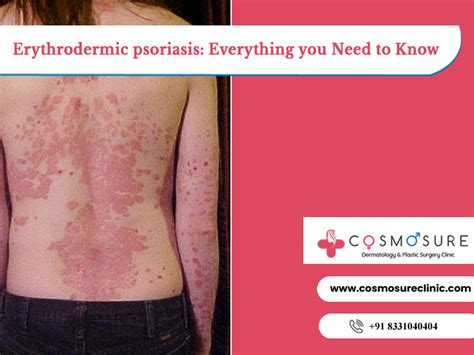 Erythrodermic Psoriasis Everything You Need To Know Cosmosure Clinic