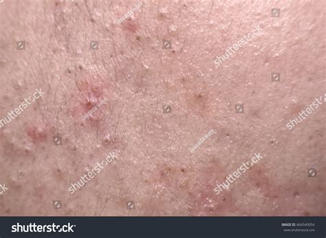 Close Nodular Cystic Acne Skin Stock Photo 664540954 Shutterstock