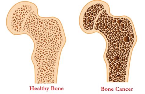 Bone Cancer Diagram