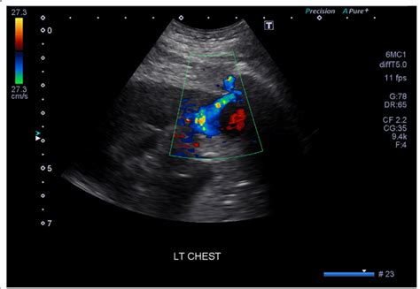 Color Doppler Ultrasound Image Of The Intercostal Artery Download