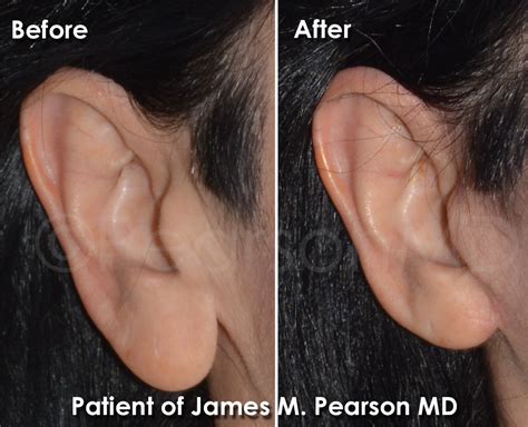 Earlobe Reduction Photos Before And After Dr James Pearson Facial Plastic Surgery