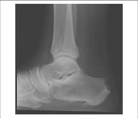Lateral View Of An Ankle Radiograph Showing A Pronounced Haglund