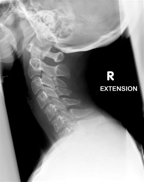 Healthy Cervical Spine Xray