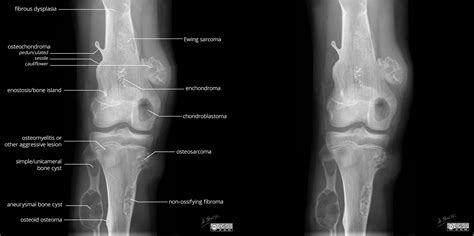 Benign And Malignant Age Less Than 30 Bone Lesions Illustration Knee