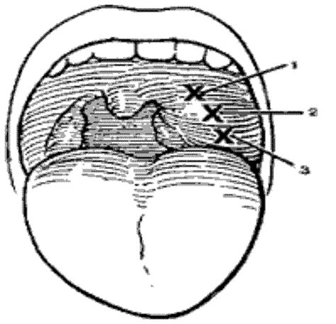 Severe Tonsillitis And Pharyngitis Ent