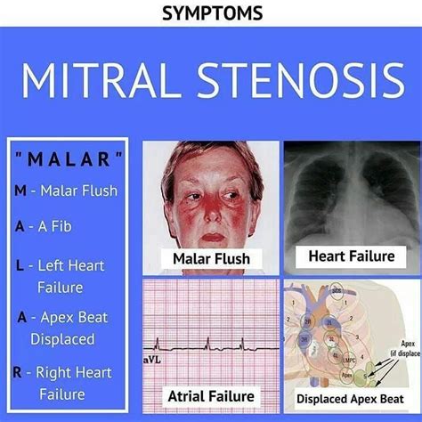 Mitral Stenosis Medicine Cardiology Medical Heart Health Education The Whitearmy Usmle