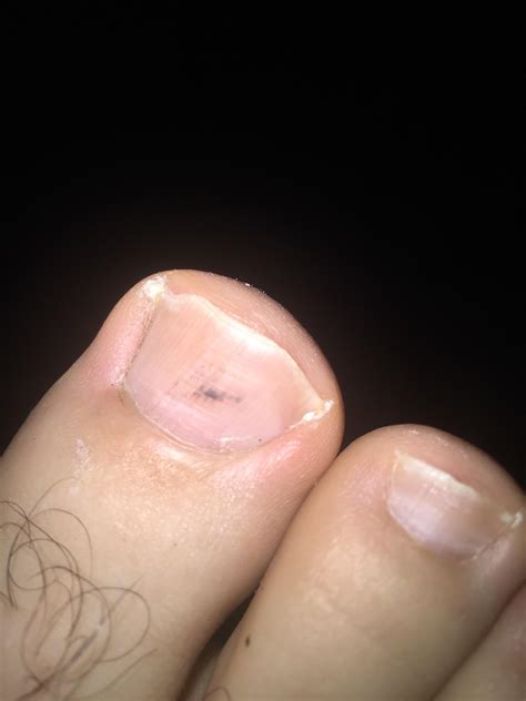 Spot toenail black under Normal Black