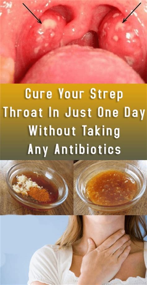 Treat Your Painful Strep Throat In Only One Day Without Needing To Take Antibiotics Wellness Digi