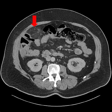 Axial View Of Ct Abdomen And Pelvis With Contrast Shows Circumscribed