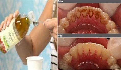 The Oldest Way To Clean The Teeth Is By Oil Pulling This Method Was