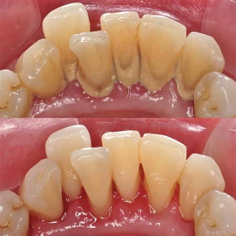 Teeth Scaling Procedure News Dentagama