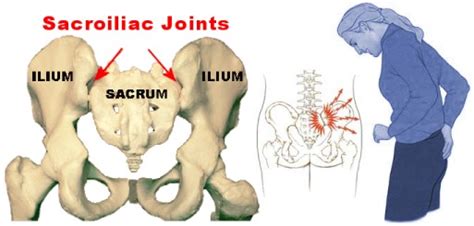 However, you can have a bulging or ruptured disk without back pain. Symptoms of Sacroiliac Pain - Neck Solutions