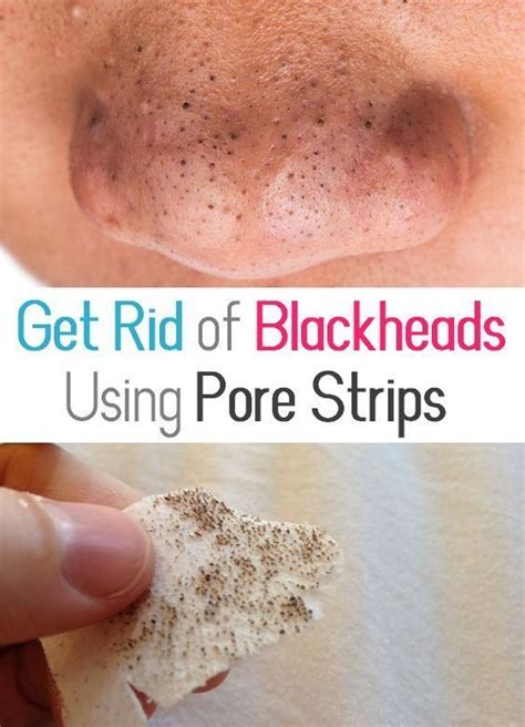 How To Get Rid Of Blackheads Completely Using Pore Strips