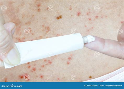 Shingles On Skin And Medicine Pharmaceutical White Tube Packaging