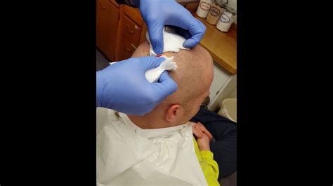 Nasty Sack Removed From Head Sebaceous Cyst Youtube