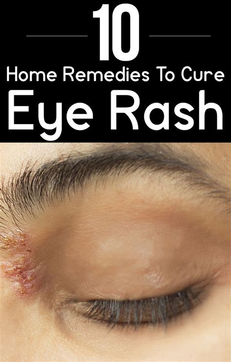 How To Soothe Irritated Skin Rashes Around The Eyes 12 Home Remedies