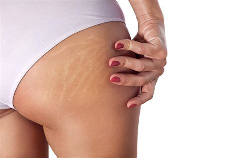 Spots Scars And Stretch Marks Lasers Can Treat Them All Z Roc