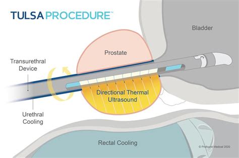 Prostate Cancer Treatment Tulsa Pro Hifu Socal Urology