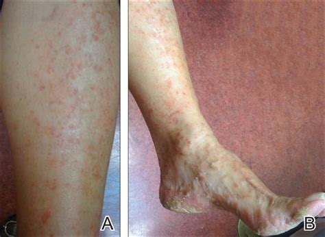 Pityriasis Lichenoides Chronica Presenting With Bilateral Palmoplantar
