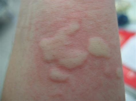 Urticaria Dr Thind