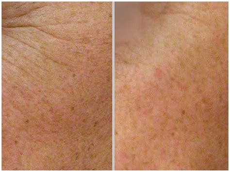 Nano Laser Peel At Pynch Anti Aging And Med Spa Services