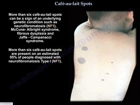 Cafe Au Lait Spots And Neurocutaneous Markers —