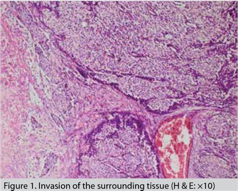 Figure 2 From Invasive Papillary Breast Carcinoma Solid Variant With