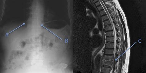 Diagnosis Of Spinal Epidural Abscess By Abdominal Plain Film